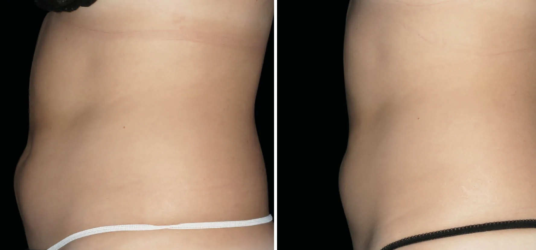 emsculpt-before-after-social
